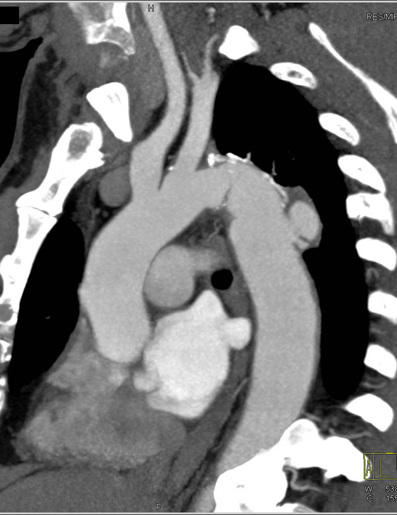 Aortic Ulceration with Intramural Hematoma - CTisus CT Scan