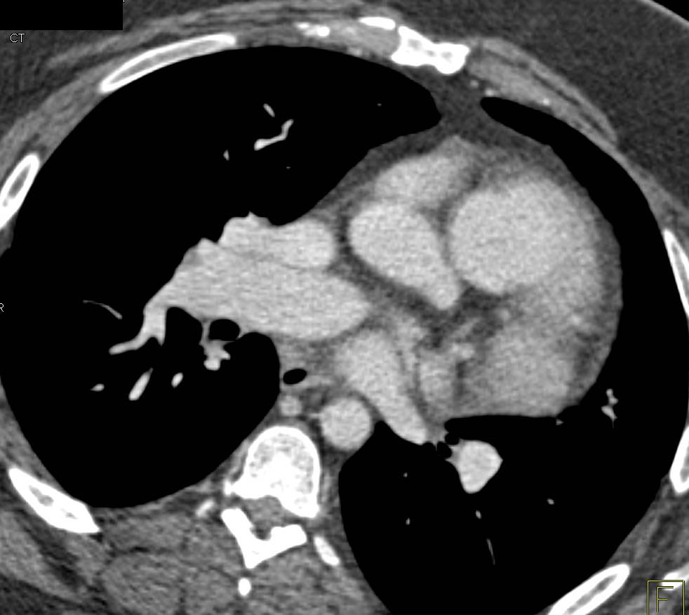 Enlarged Right Pulmonary Vein - CTisus CT Scan