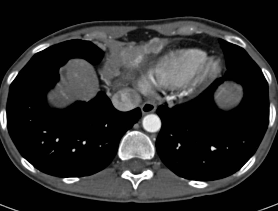 Carcinomatosis as well as Paracardiac Nodes - CTisus CT Scan
