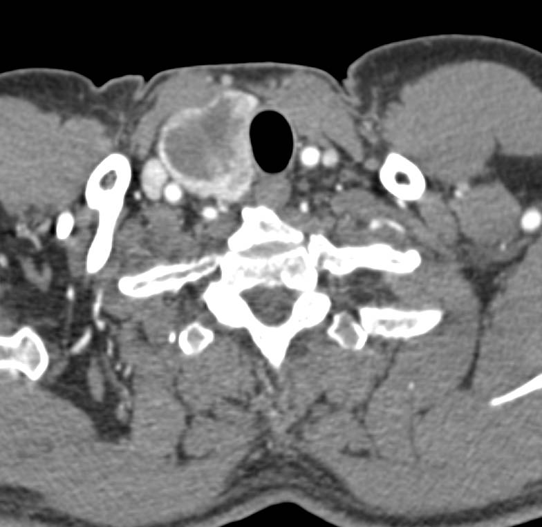 Thyroid Goiter - CTisus CT Scan