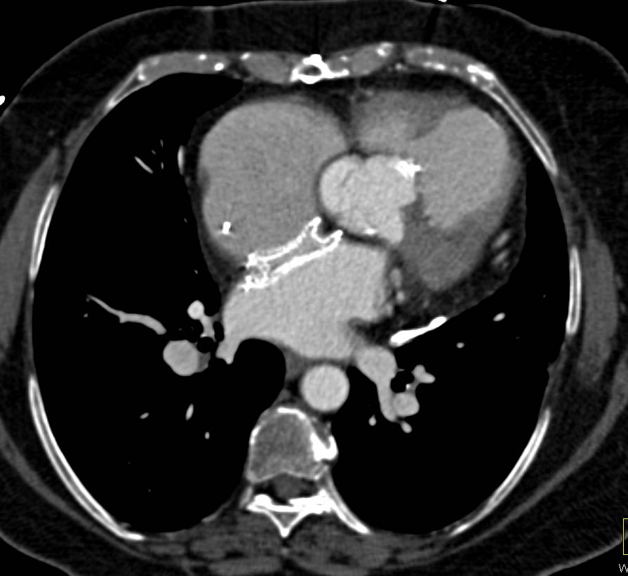 Dilated Ascending Aorta in patient with Aortic Valve Disease as well as Prior Atrial Septal Defect (ASD) Repair - CTisus CT Scan