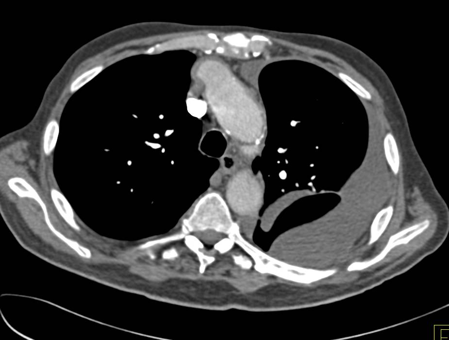 Empyema - CTisus CT Scan