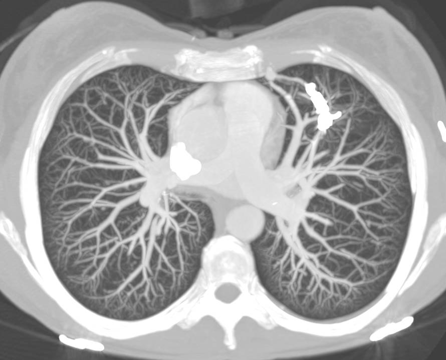 Pulmonary Arteriovenous Malformations (PAVMs) with Prior Embolizations of PAVMs in Patient with Osler Weber Rendu Syndrome - CTisus CT Scan