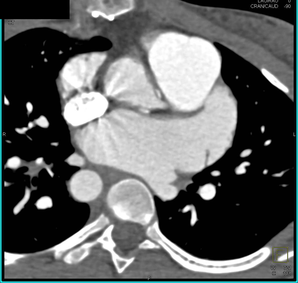 Pseudo-Coarctation of the Aorta with Compression of the Airway - CTisus CT Scan