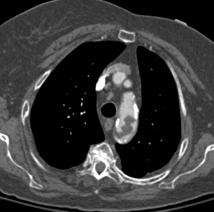 Ulcerating Plaque in Descending Thoracic Aorta and Thrombus in Arch - CTisus CT Scan