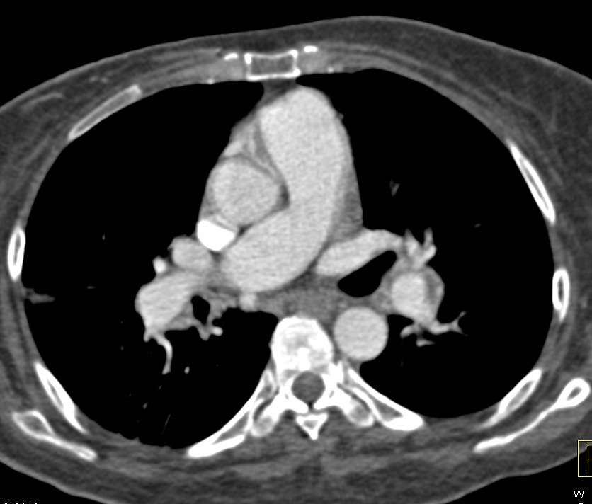 Chronic Pulmonary Embolism Left Main Pulmonary Artery - CTisus CT Scan