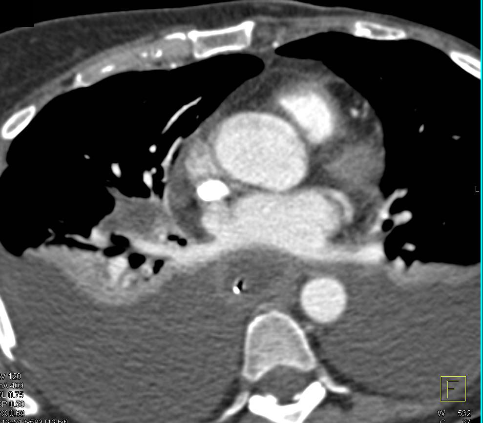 Large Pleural Effusions due to Subdiaphragmatic Abscess - CTisus CT Scan