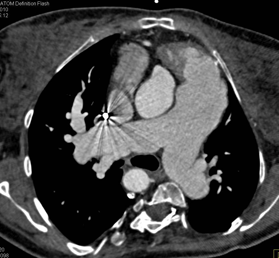 Pulmonary Hypertension and Enlarged Pulmonary Arteries - CTisus CT Scan
