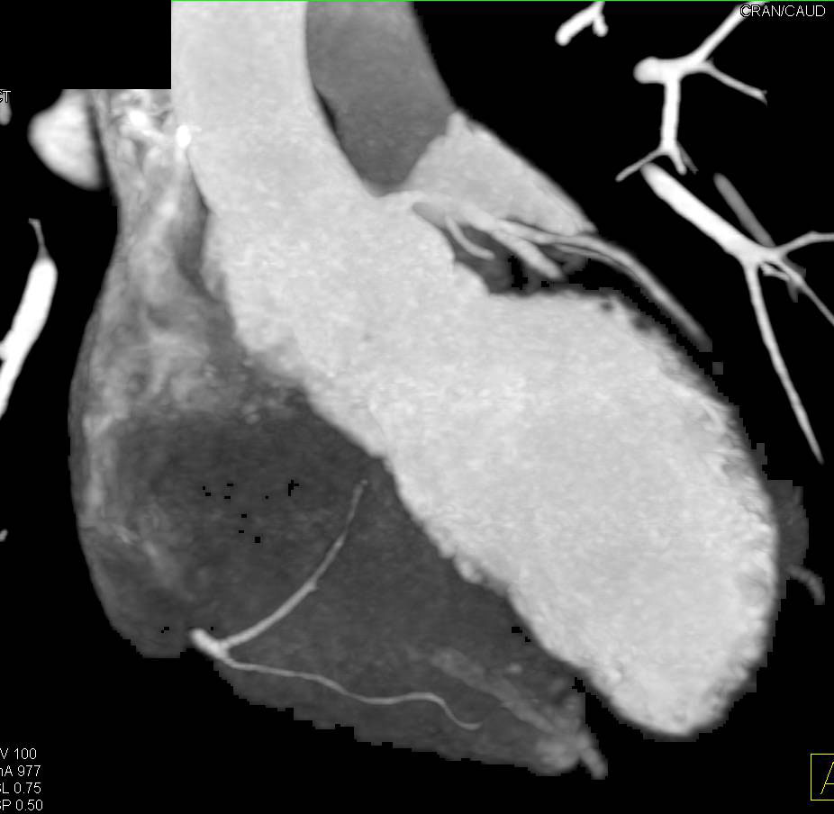 CCTA: Normal Coronary Artery Study with Various Displays and Nice Views of the Pulmonary Veins - CTisus CT Scan