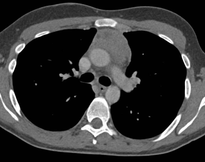 Prominent Thymus in a 25 Year Old - CTisus CT Scan