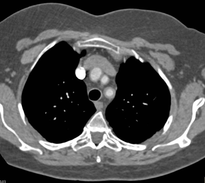 Takayasu's Arteritis Involves Left Subclavian Artery and Arch - CTisus CT Scan