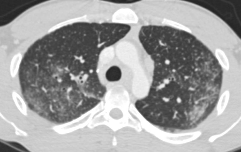 Acute Pneumonitis due to Mycobacterium avium/intracellulare (MAI) Infection - CTisus CT Scan