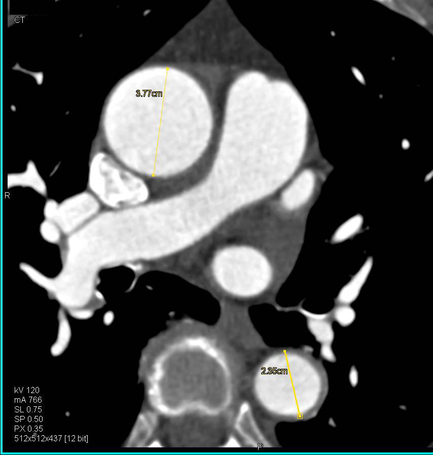 Dilated Ascending Aorta with thickened Aortic Valve Leaflets - CTisus CT Scan