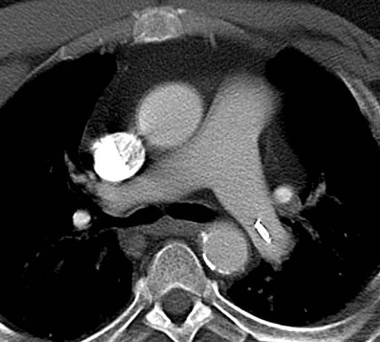 Broken Catheter Lodges in the Left Main Pulmonary Artery - CTisus CT Scan