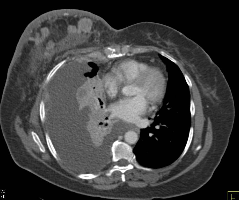 3D Imaging of an Ulcerating Breast Cancer with Adenopathy as well as Pleural and Parenchymal Metastases - CTisus CT Scan