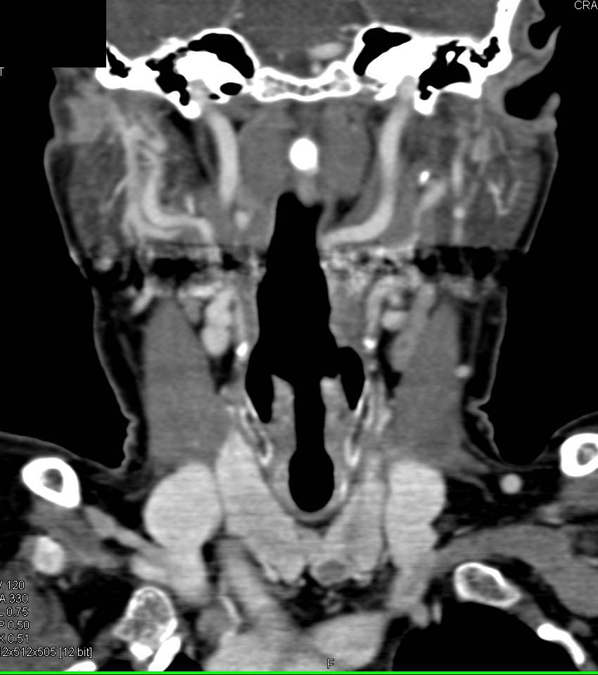 Nodule in Lower Left Lobe of Thyroid Gland was a Parathyroid Adenoma - CTisus CT Scan