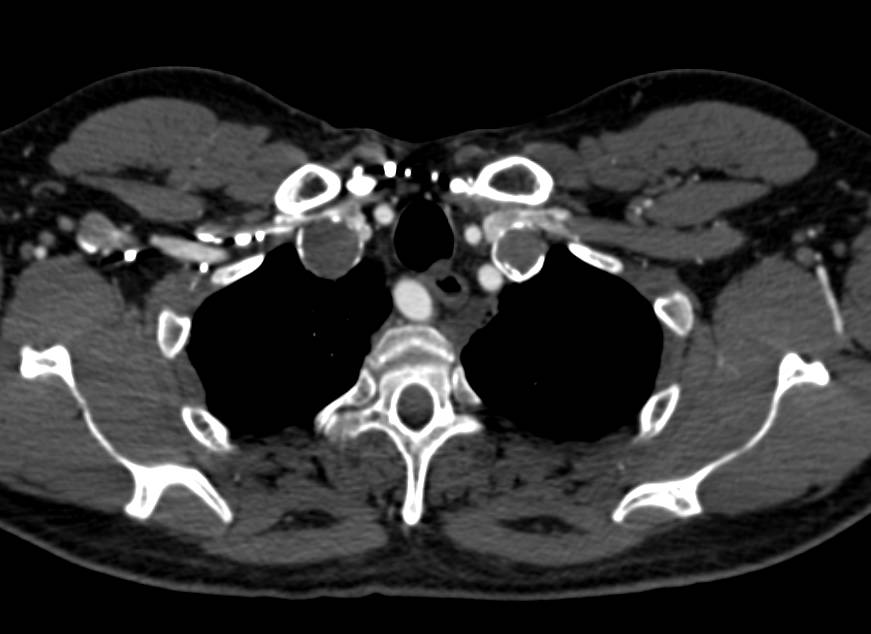 Bilateral Subclavian Artery Aneurysms with Large Right Renal Artery Aneurysm - CTisus CT Scan