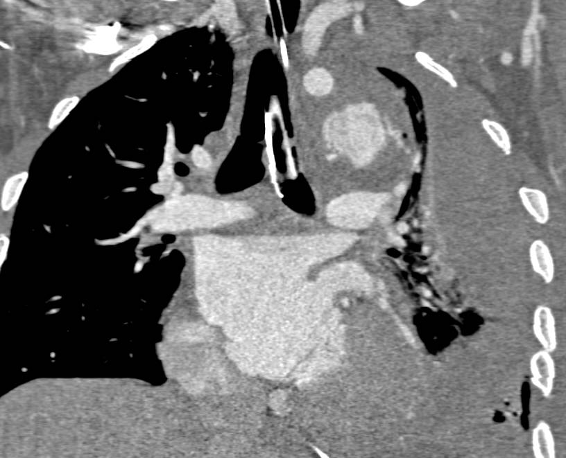 Endotracheal Tube Extends into the Left Mainstem Bronchus - CTisus CT Scan