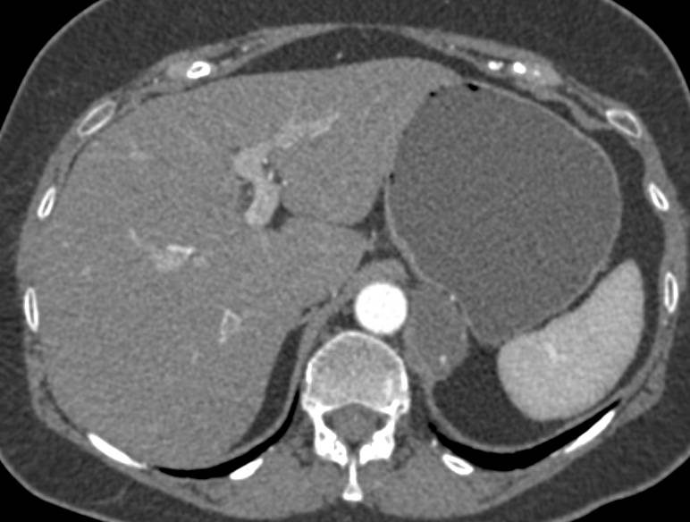 Extralobar Sequestration on Left - CTisus CT Scan