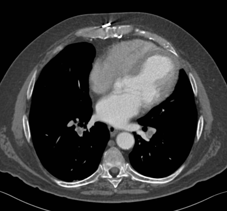 Incidental Pulmonary Embolism (PE) in Oncology Patient - CTisus CT Scan