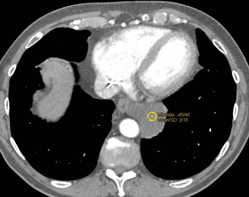 Bronchogenic Cyst - CTisus CT Scan