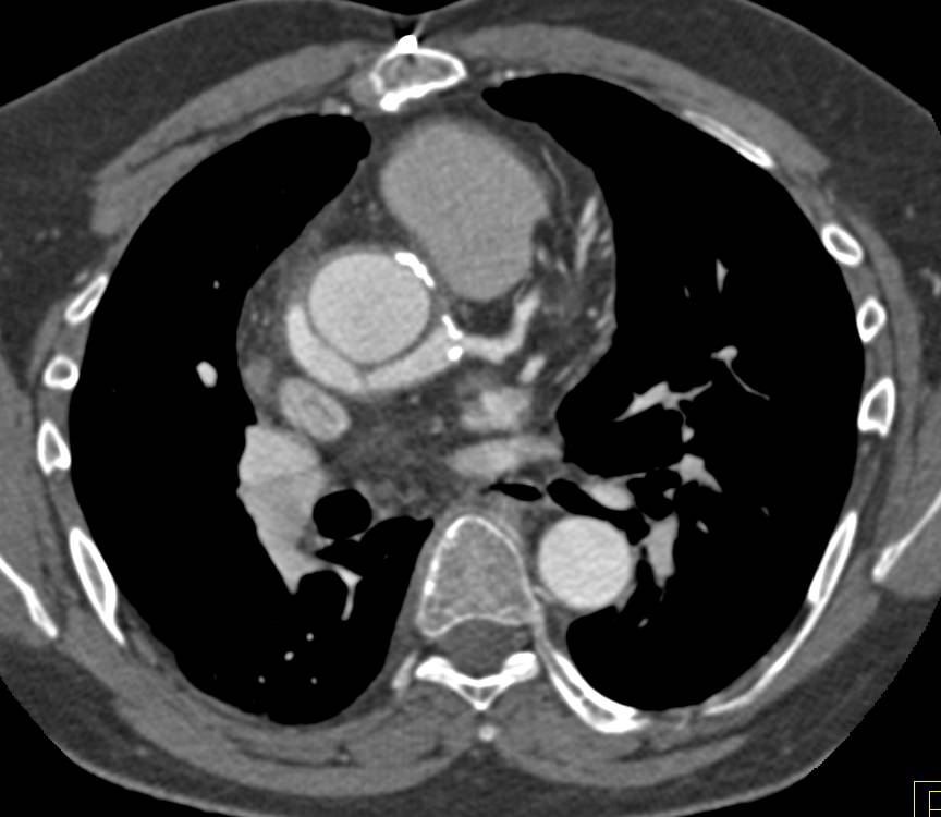 Repair of Aortic Root and Valve with Coronary Artery Graft Also Positioned on 3D - CTisus CT Scan