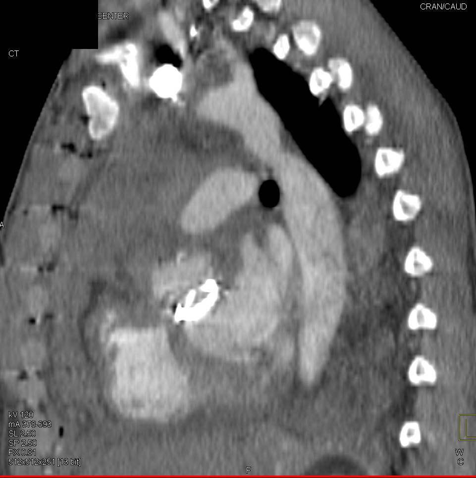 Dissection of the Aorta in a Patient with Prior Coarctation Repair with Increased Flow Through the Internal Mammary Artery - CTisus CT Scan