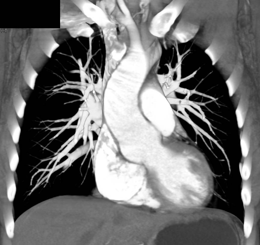 Pseudo clot in Superior Vena Cava (SVC) - CTisus CT Scan