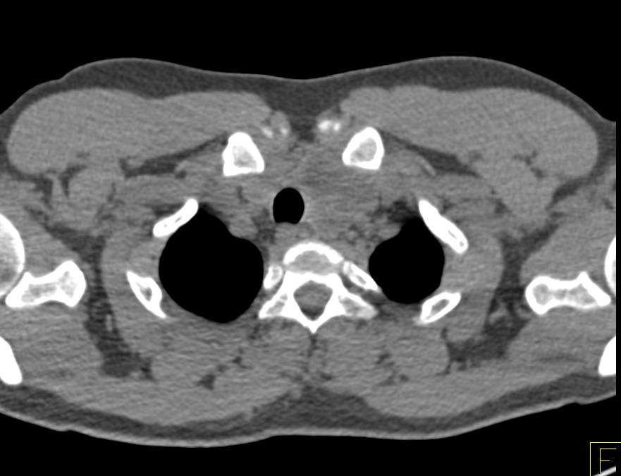 Substernal Thyroid Pushes on Airway - CTisus CT Scan