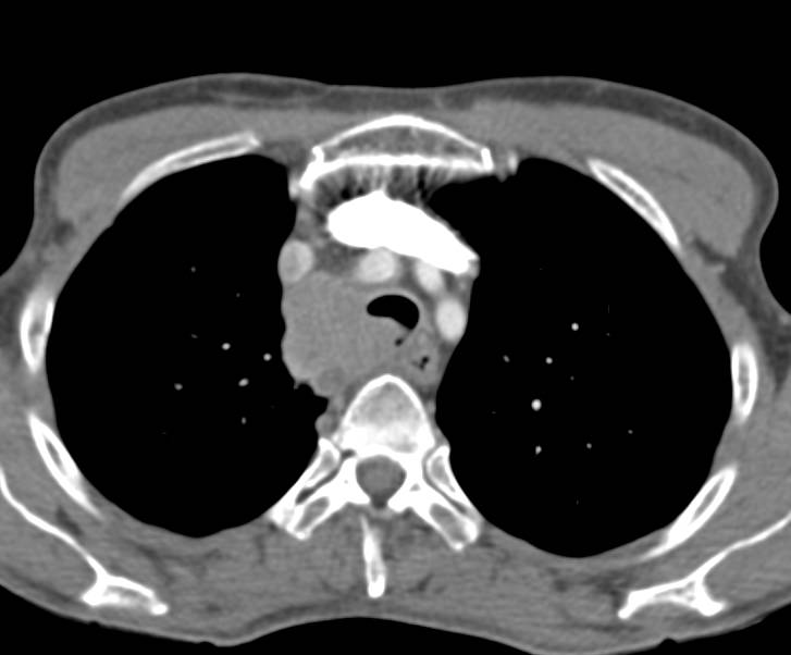 Primary Tracheal Tumor with Mediastinal Adenopathy - CTisus CT Scan