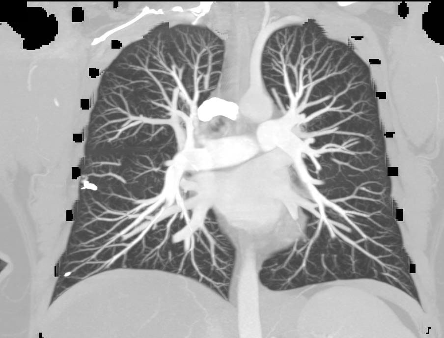 Analysis of CTA in Patient with Embolization of Multiple Pulmonary Arteriovenous Malformations (PAVMs) - CTisus CT Scan