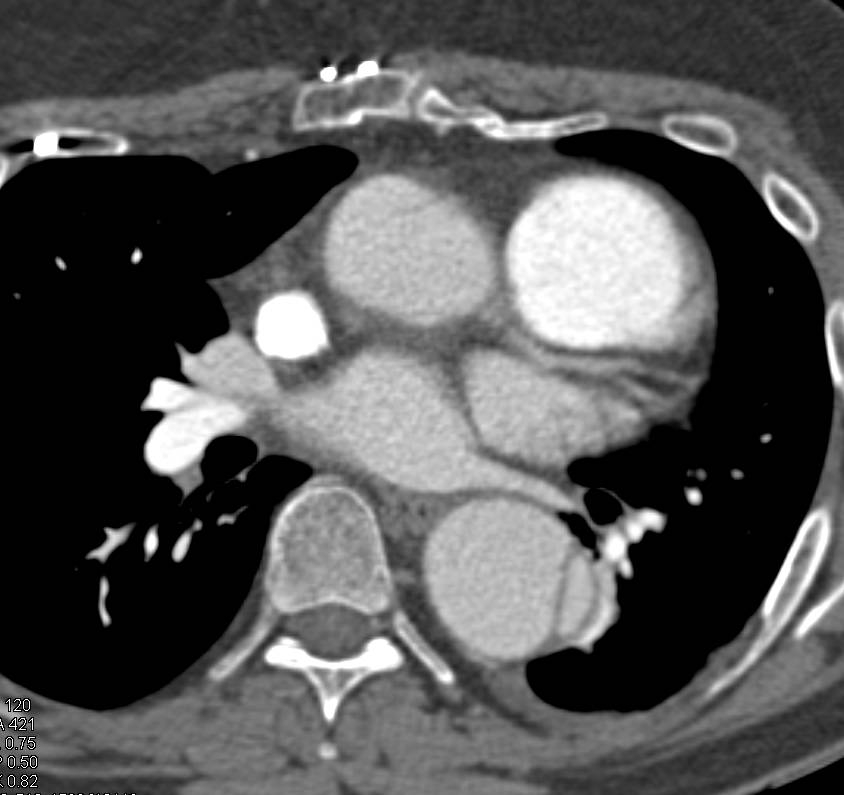 Type A Dissection of the Aorta - CTisus CT Scan