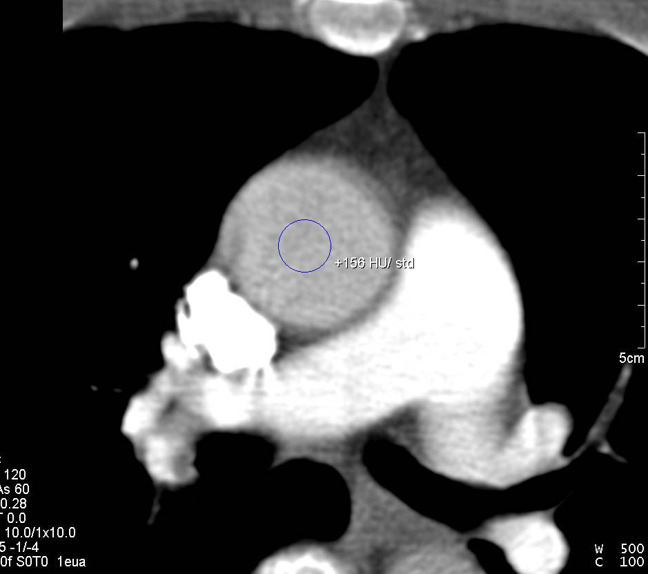 Bolus Tracking for Aortic Evaluation - Chest Case Studies - CTisus CT ...