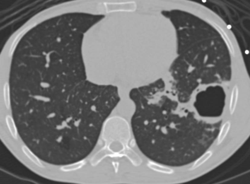 Pulmonary Aspergillosis with Multiple Cavities - CTisus CT Scan