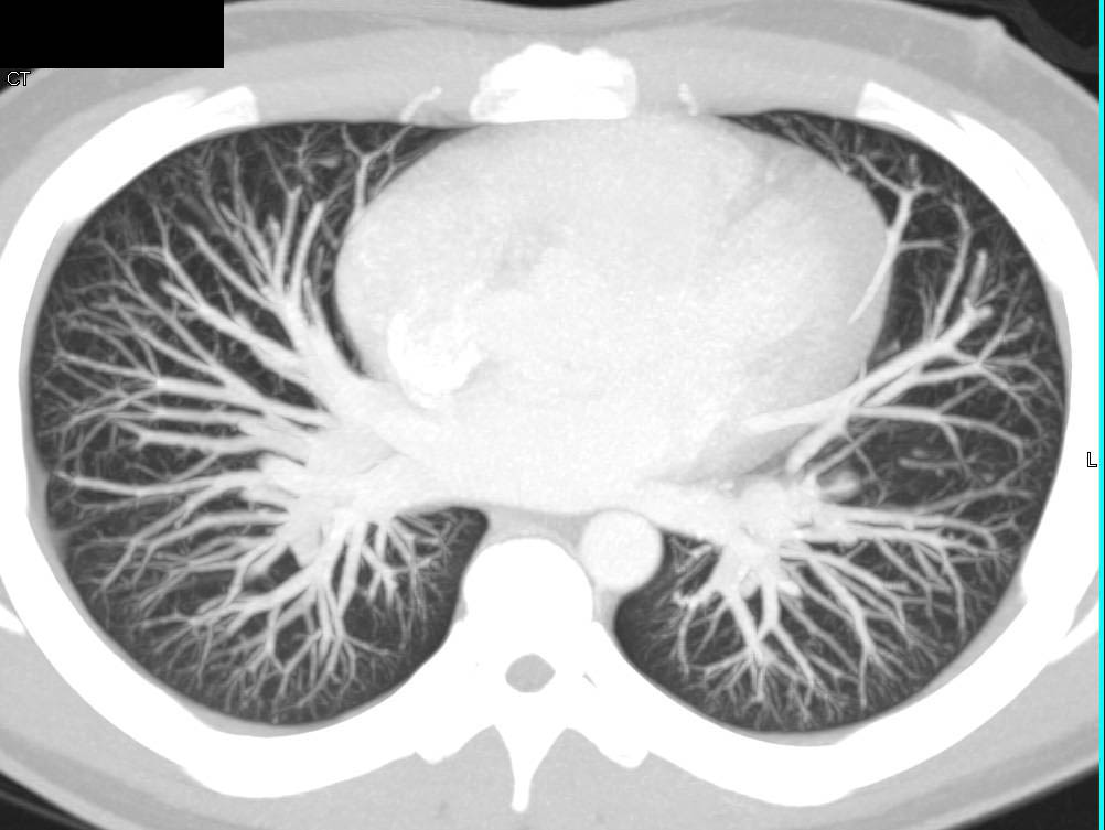 MIP Display of the Pulmonary Arteries - CTisus CT Scan