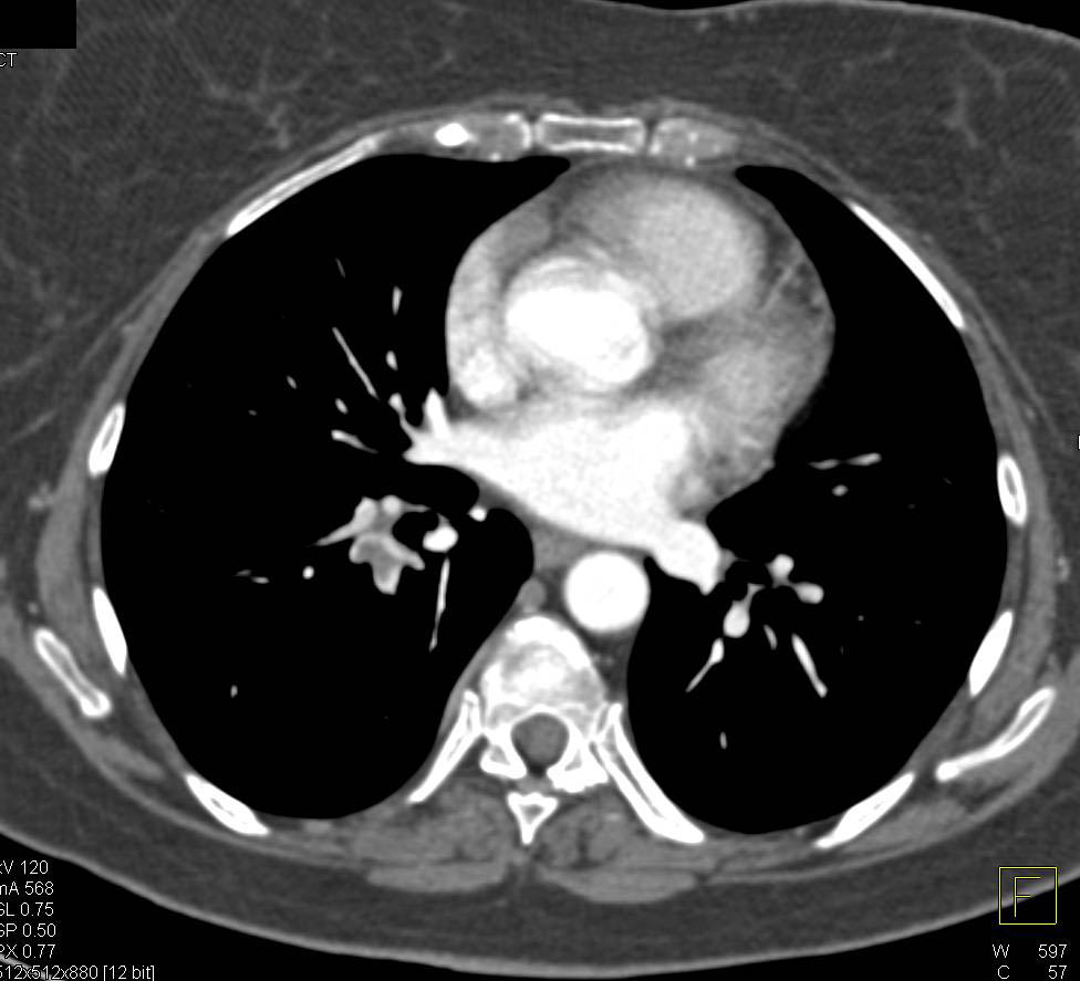 Pulmonary Embolism - CTisus CT Scan