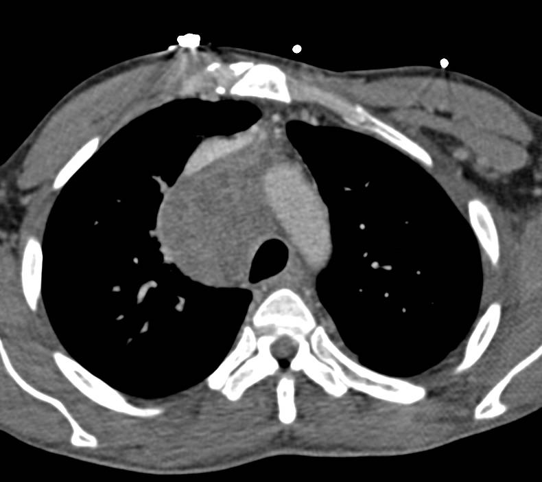 Metastatic Melanoma to Chest, Chest Wall and Muscle as well as Adrenal Gland - CTisus CT Scan