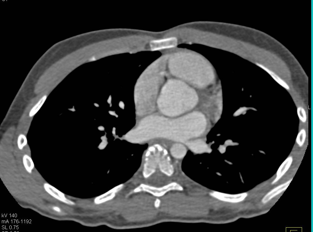 Dilated Sinus of Valsalva in a Patient with Marfan Syndrome - CTisus CT Scan