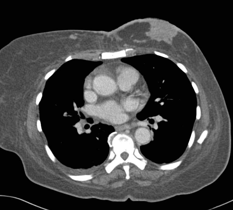 Infiltrating Breast Cancer - CTisus CT Scan