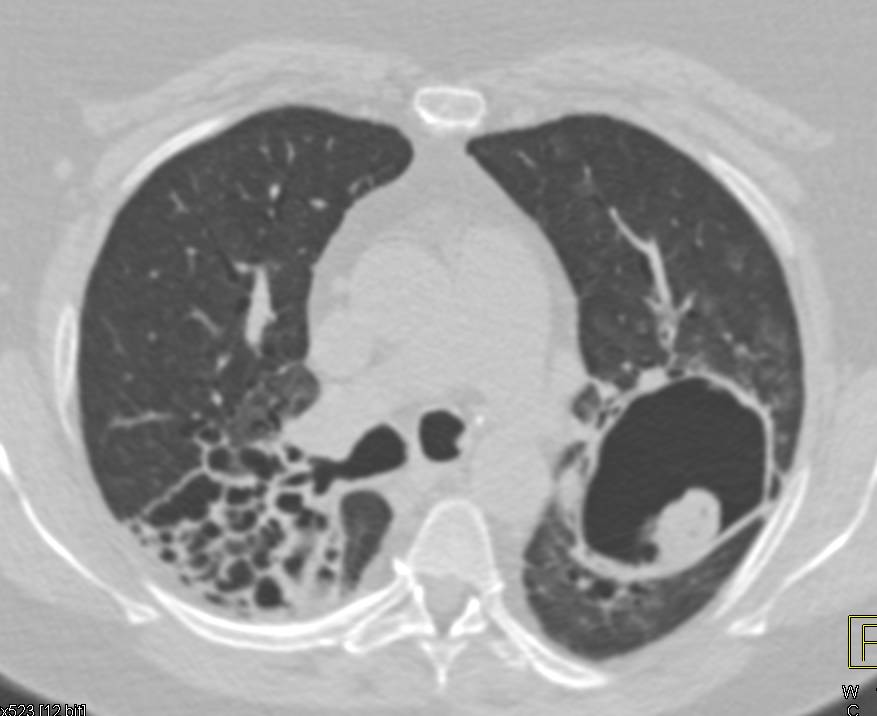 Sarcoidosis Complicated by Invasive Pulmonary Aspergillosis - CTisus CT Scan