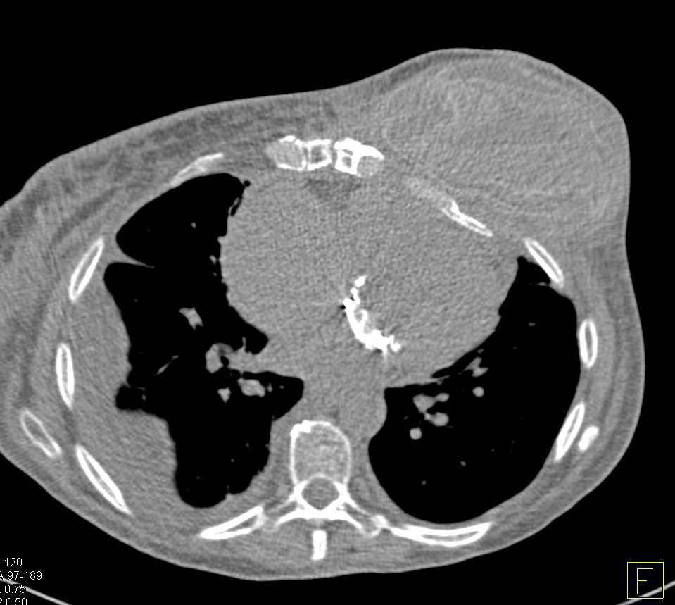 Failed Breast Prosthesis - CTisus CT Scan