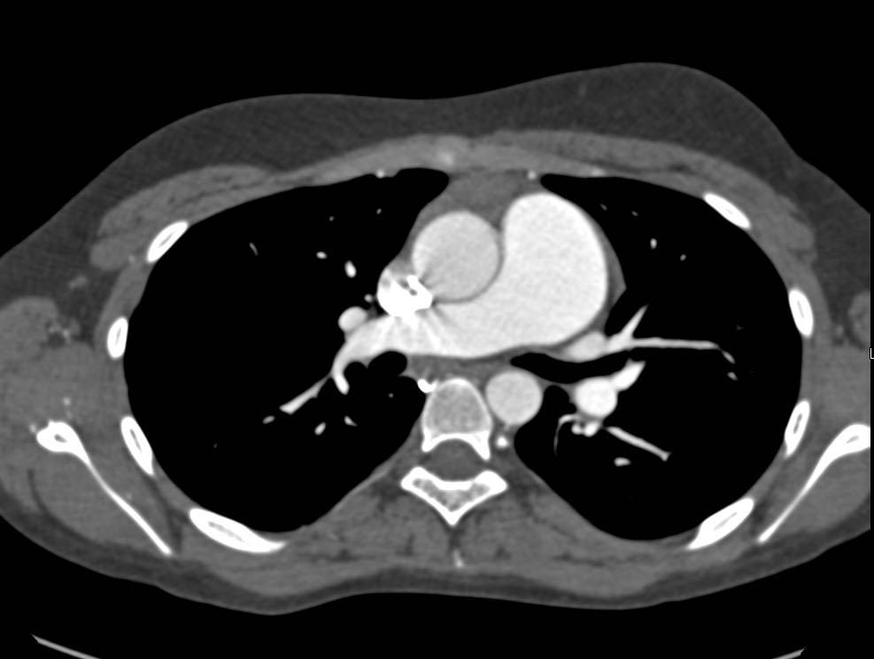 Pulmonary Hypertension Chest X Ray 5132