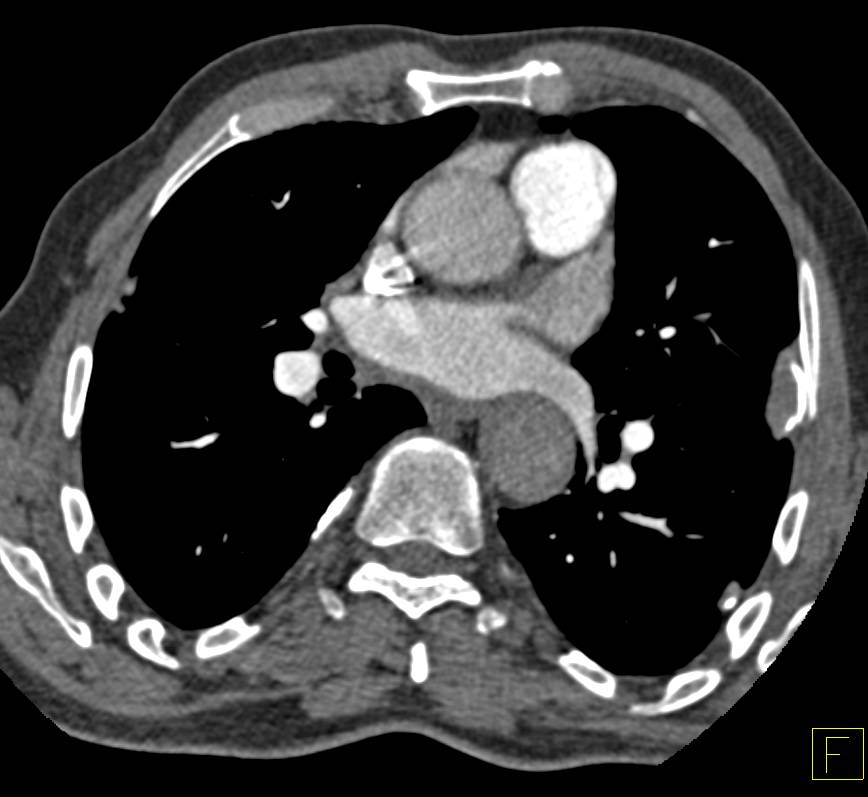 Enlarged Pulmonary Arteries and Pulmonary Hypertension. Pleural Plaques also Seen. - CTisus CT Scan