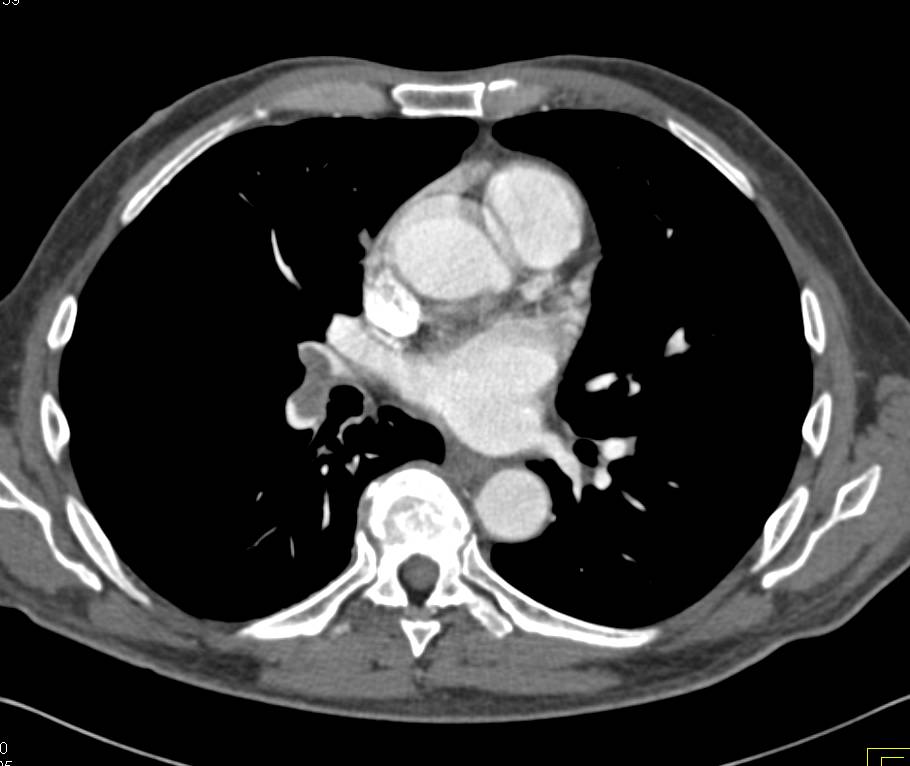 Pulmonary Embolism - CTisus CT Scan