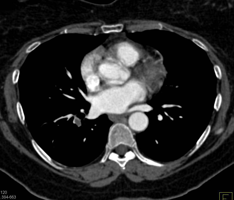 Incidental Pulmonary Embolism (PE) in Oncology Patient - CTisus CT Scan