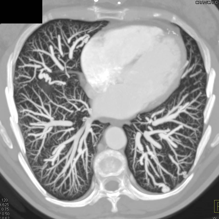 Multiple Bilateral Pulmonary Arteriovenous Malformations (PAVMs) in a Patient with Hereditary Hemorrhagic Telangiectasia (HHT) Syndrome. Incidental Splenic Artery Aneurysm - CTisus CT Scan