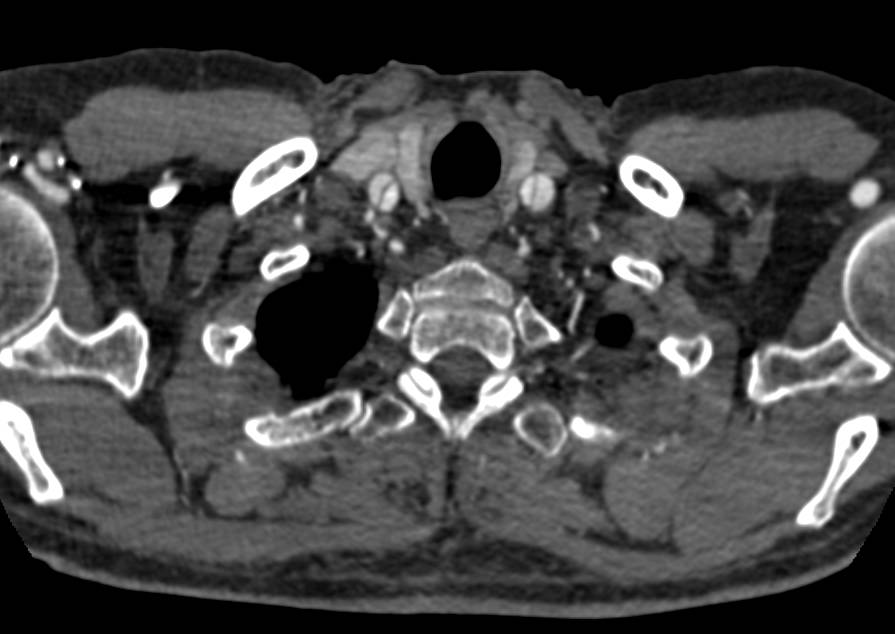 Type A Dissection with Ascending Aorta and Root Repair with Dissection Extending into the Great Vessels off the Arch - CTisus CT Scan