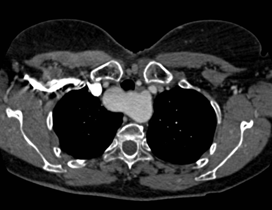 Aberrant Right Subclavian Artery with Ductus of Kummeral Aneurysm - CTisus CT Scan