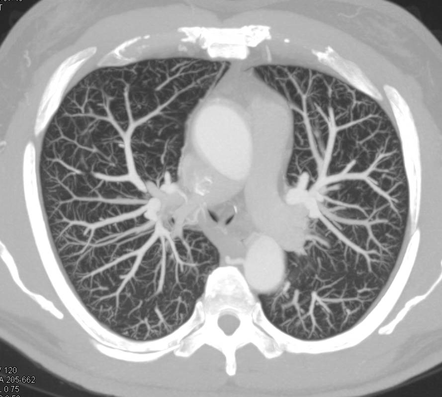 MIP Imaging Looking for a Pulmonary Arteriovenous Malformation (PAVM) - CTisus CT Scan