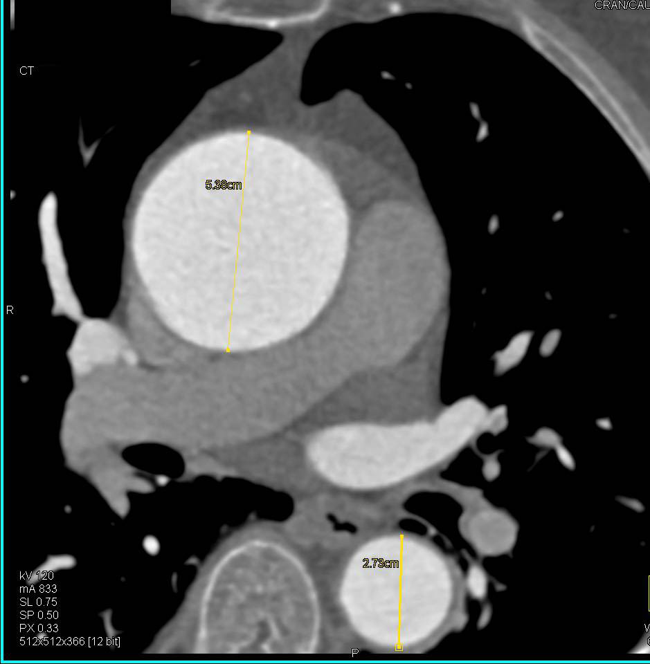 Dilated Ascending Aorta in Patient with Aortic Stenosis. Center-Line Tool Defined - CTisus CT Scan